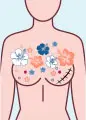 Cancer des seinsDécryptage biomédical des cancers des seins